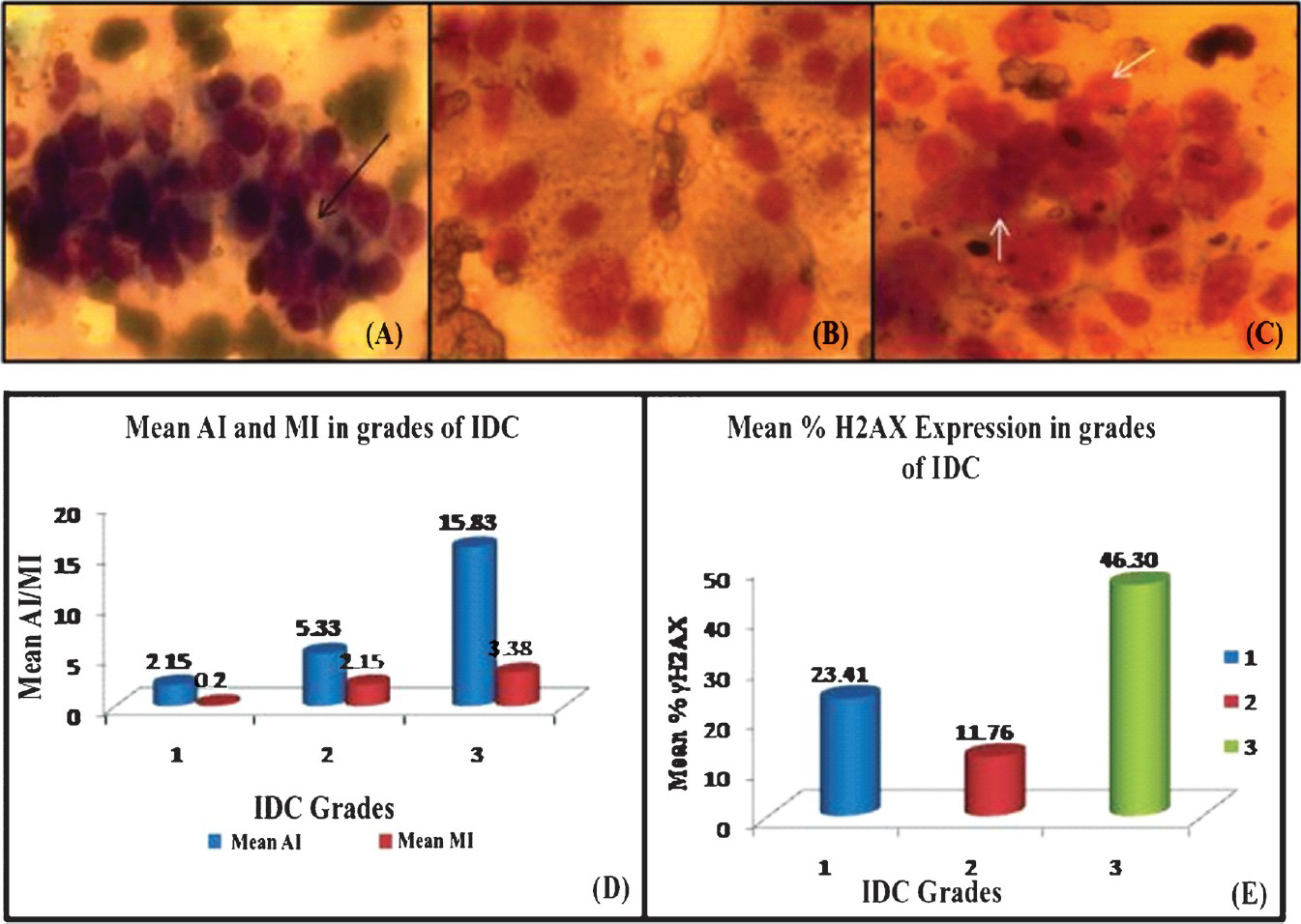 (A, B, C) Microphotographs showing cytological grading of IDC in FNAC smears. 2A shows grade 1 cancer with, cohesive cells, minimal pleomorphism and gland like structures (arrow black); 2B shows grade 2 cancer with moderate degree of pleomorphism and cellular discohesion; 2C shows grade 3 cancer with poorly differentiated cells exhibiting marked nuclear pleomorphism and nucleolar prominence (arrow white) (Giemsa staining) (D) Increased mean values of both AI and MI with increase in cytological grade of cancer (E) %γH2AX expression in different grades of IDC. Note the much higher expression in grade 3 as compared to the other grades of IDC.