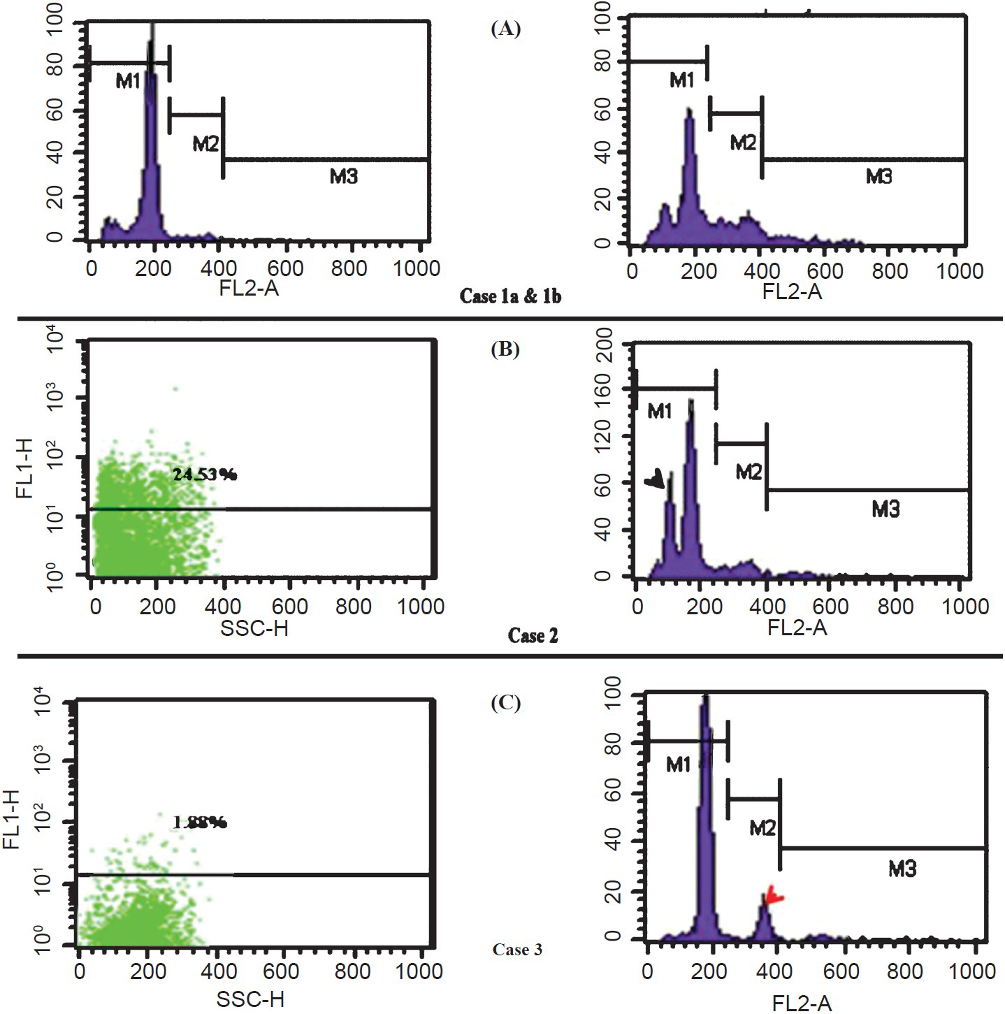 (A) Case 1a: DNA diploid histogram of case of FA. Corresponding γH2AX expression is shown in Fig. 1E; Case 1b: DNA diploidy with high SPF in DNA histogram of a case of IDC. Corresponding high γH2AX expression is shown in Fig. 1D (B) Case 2: A case of IDC showing hypodiploid aneuploidy (black arrowhead) with 24.53% population showing γH2AX expression (C) Case 3: A case of IDC showing small aneuploid peak and low (1.88%) γH2AX expression (red arrowhead).