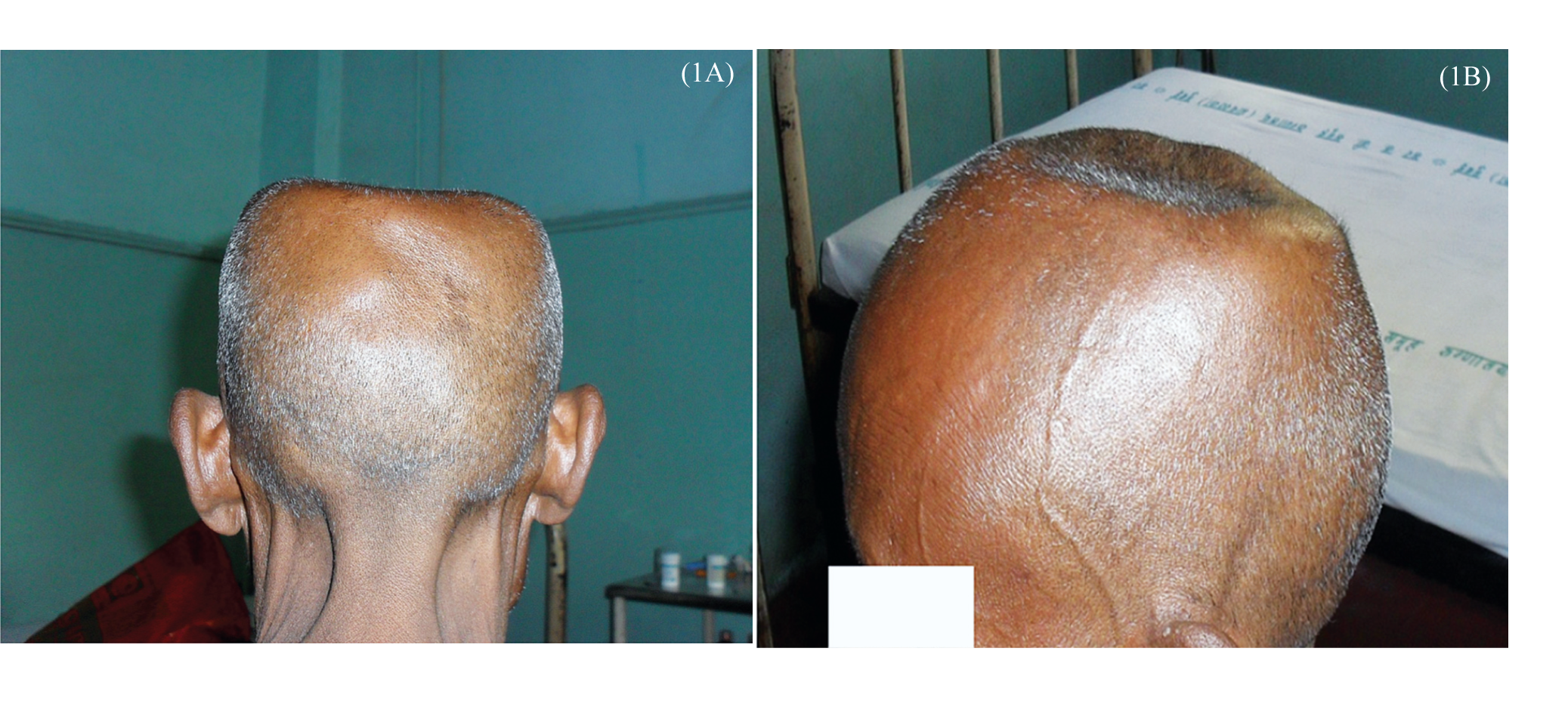 Shaved head of the patient showing the central excavatory area. (A) Posterior view (B) Lateral view.