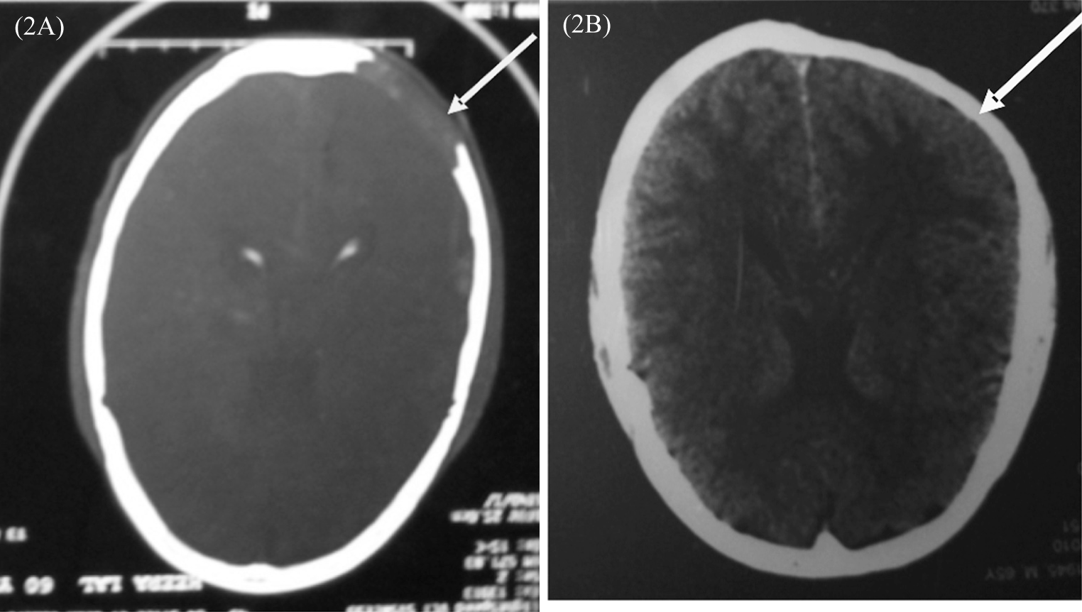 CT Scan showing the lytic skull lesion and its resolution by thalidomide therapy.