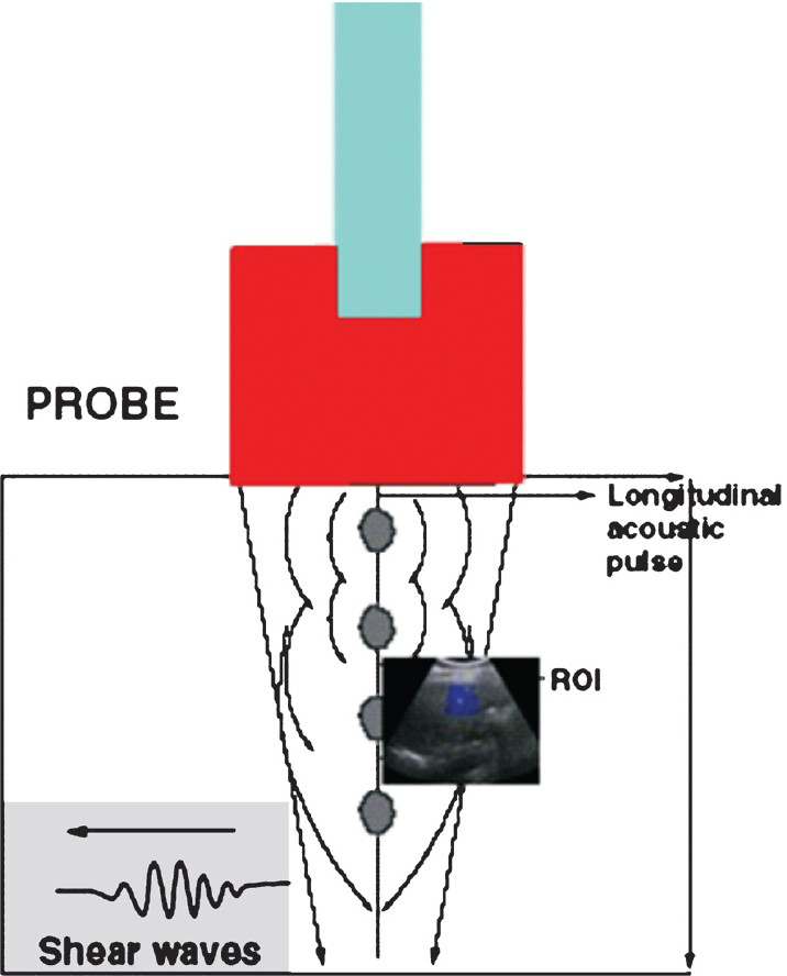 Schematic image showing physical principles of ultrasonographic shear wave elastography. Transmission of longitudinal acoustic pulse leads to tissue displacement, which results in propagation of shear waves away from region of interest (ROI) with ultrasound tracking beams lateral to single push beam.