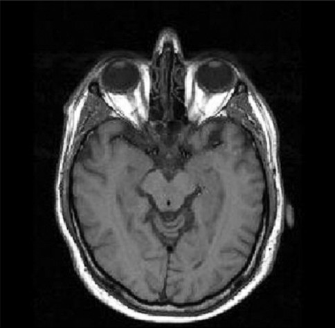 T1 weighted MR image of the brain