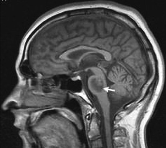 Brain MRI of the patient showing a low T1 signal intensity lesion (day 14).