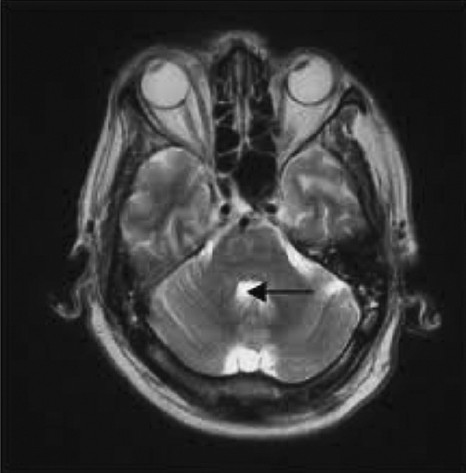 T2 - weighted image of hyperintensity in the pons (black arrow) consistent with CPM (day 14).