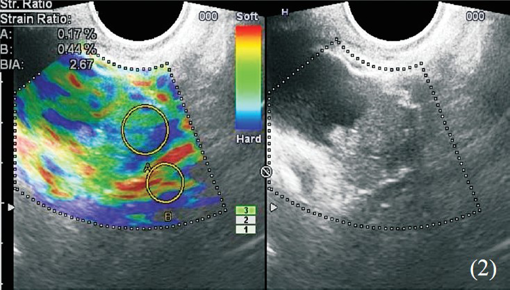 Left ovarian cyst with solid nodular component, coded type 2 colour pattern on elastogram, histopathologic evaluation revealed cyst adenoma.