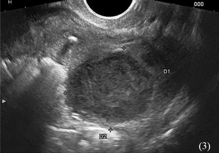 B-mode ultrasonography of ovarian cyst with heterogeneous components, histopathologic evaluation revealed dermoid cyst.