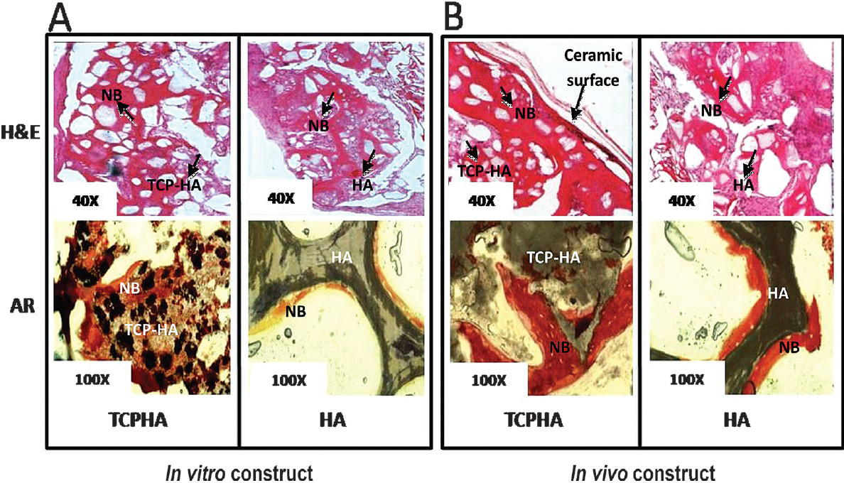Light microscopic images of HA-SMC and TCP/HA-SMC three dimensional construct implanted in mice. (A) TCP/HA-SMC construct revealed new bone (NB) formation with some ceramics and fibrous tissue still seen. More bone area detected as compared to HA-SMC in both staining, H&E and Alizarin Red. (B) formation of new bone with a high surface area, and cell-shaped void embedded in the bone for TCP/HA-SMC construct. In HA-SMC construct there were lots of fibrous intrusion. AR staining confirmed more mineral activity in in vivo level both HA-SMC and TCP/HA-SMC Constructs.