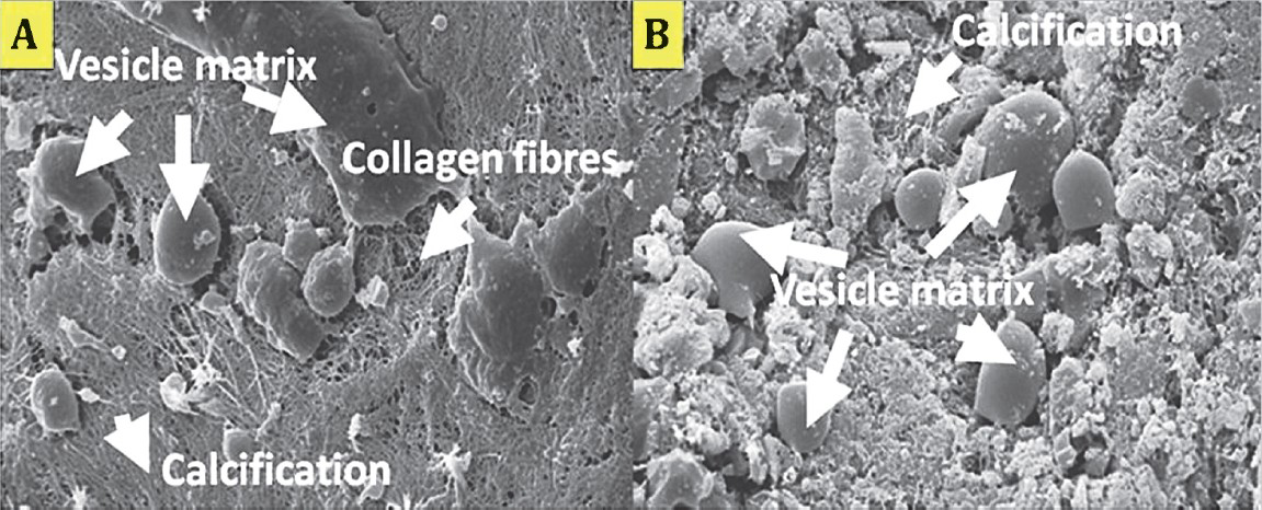 Scanning electron micrograph of HA-SMC and TCP/HA-SMC constructs in osteogenic medium for three weeks. Flattened cells were detected attached to the constructs and started to proliferated and secreting matrix. (A) In TCP/HA-SMC constructs, a lots of calcification process and vesicles matrix were detected. (B) In HA-SMC constructs, less vesicles matrix and collagen fibres can be seen.