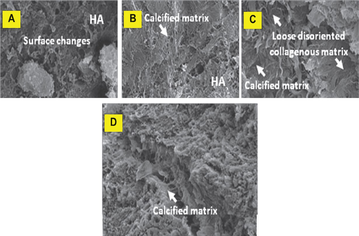 Scanning electron micrographs of HA-SMC scaffolds. Stages of matrix maturation in in vivo HA-SMC post-implantation (oppositional bone growth). (A and B) Cells transforming into mineralized. (C and D) sheets which then broke off to fuse with other nodules, then produced the overall bone-like matrix.