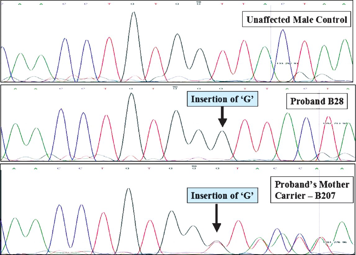Sequence analysis of the DMD gene in a control sample, proband and his mother showing point mutation in exon 51 and the corresponding mutation in the mother causing a frameshift in one of the alleles.