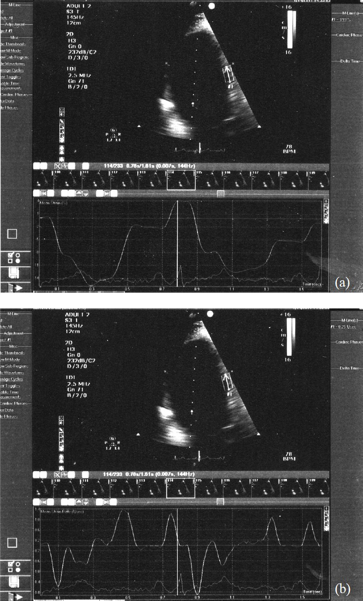 Four chamber view images with strain (a) and strain rate (b) analysis of the mid segment of interventricular septum in a control subject.