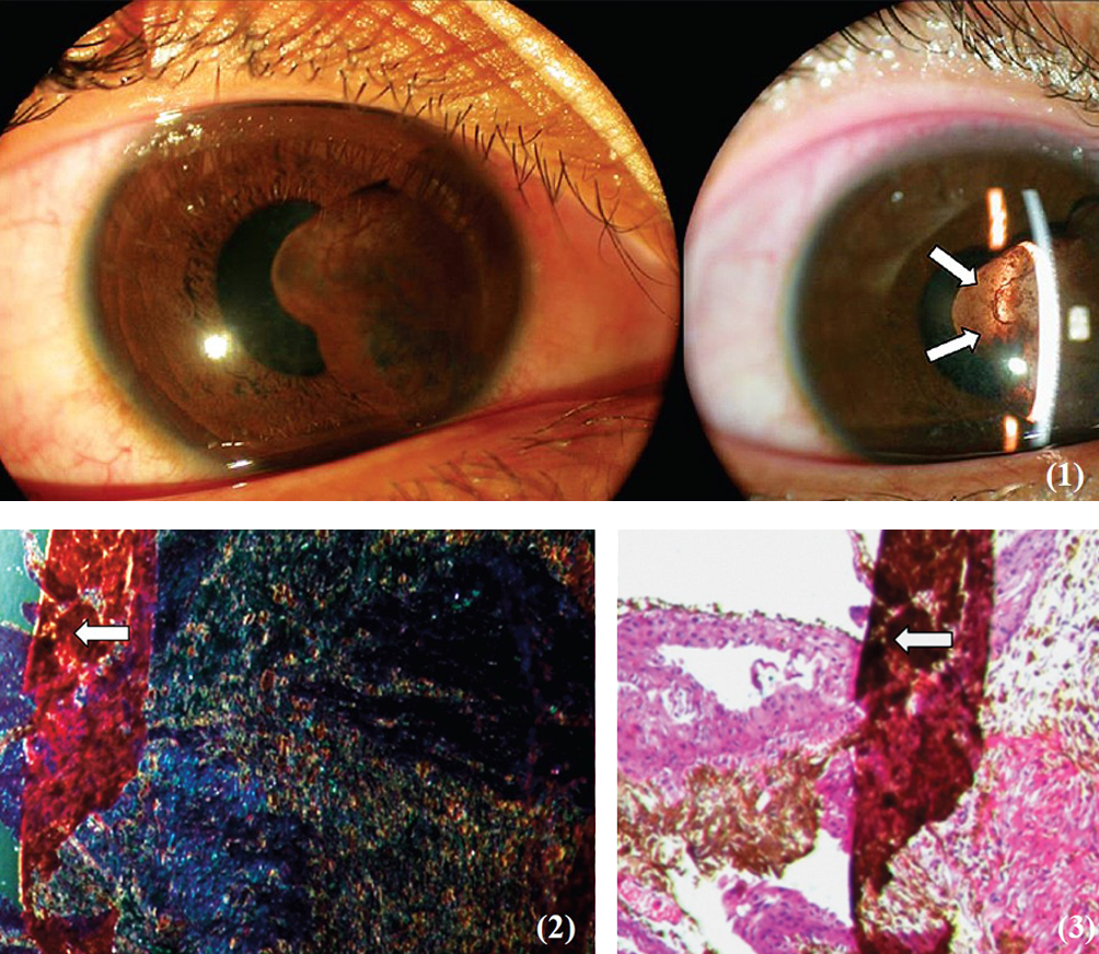 Slit lamp biomicroscopy showing a transillu minant iris cyst on medial aspect of iris (arrows) (Fig. 1). Diffraction cytology (Fig. 2) and histopathological examination with Haematoxylin and Eosin stain of the excised tissue. (Fig. 3) showing presence of a foreign body (arrow in Figs 2 and 3×200).