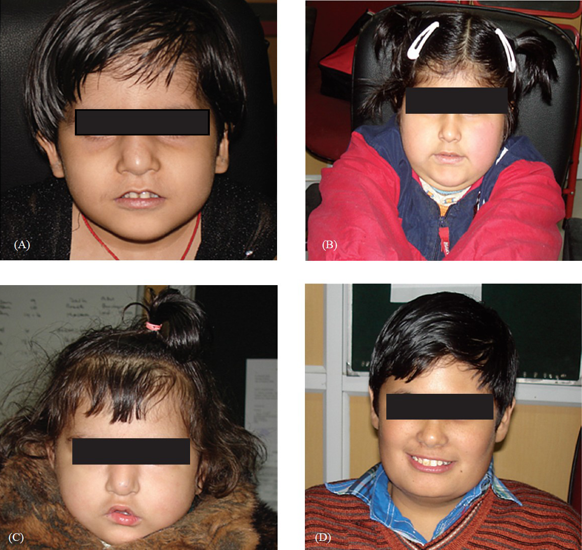Shows facial profile of microdeletion positive cases (A: 22q11.2 microdeletion; B: Prader-Willi syndrome; C: mosaic 22q11.2 microdeletion; D: mosaic Prader-Willi syndrome).