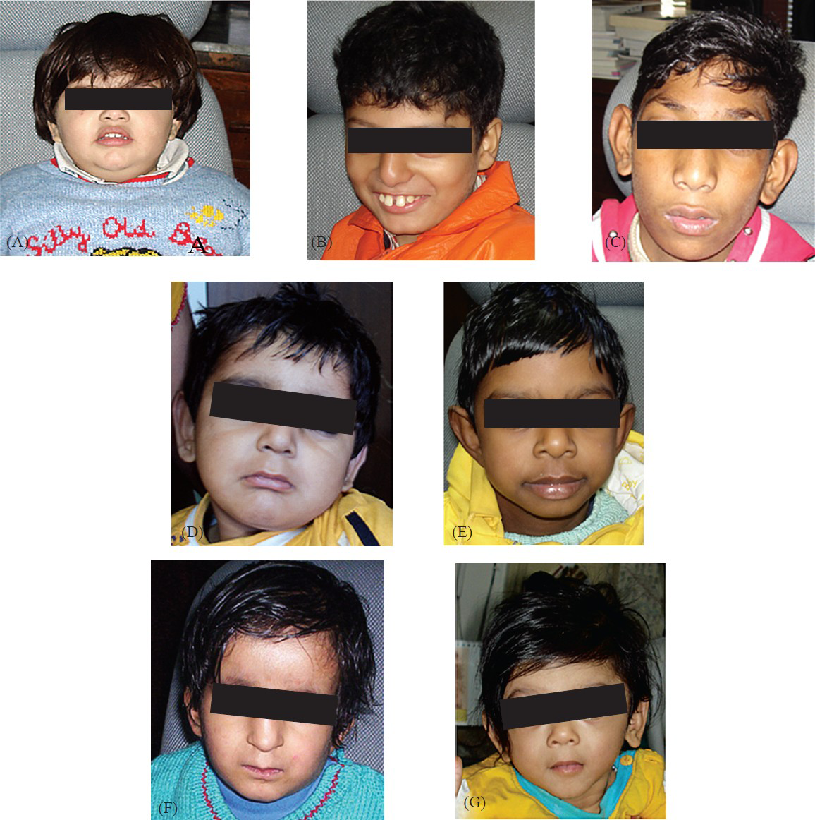 Shows facial profile of microdeletion negative cases (A: suspected Prader-Willi syndrome; B: suspected Angelman syndrome; C: suspected 22q11.2 microdeletion; D: suspected Miller-Dieker/Lissencephaly syndrome; E: suspected Williams syndrome; F: suspected Wolff Hirschhorn syndrome; G: suspected 1p36.3 microdeletion syndrome).
