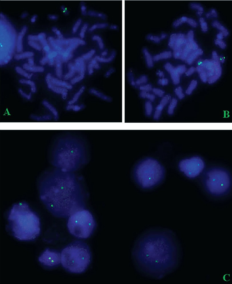Shows FISH image of clinically suspected microdeletion cases (A: hemizygous microdeletion i.e., only one chromosome shows FISH signal; B: normal dizygous state i.e., both chromosomes show FISH signal; C: mosaic hemizygous microdeletion i.e., interphase cells with one as well as two FISH signals).