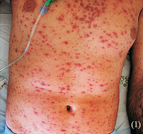 Skin examination: Polymorphic pruritic rash with macular, vesicles, pustules and crusty lesions.