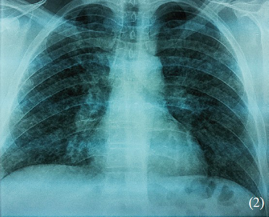 Chest radiographic: Bilateral multinodular interstitial infiltrates.