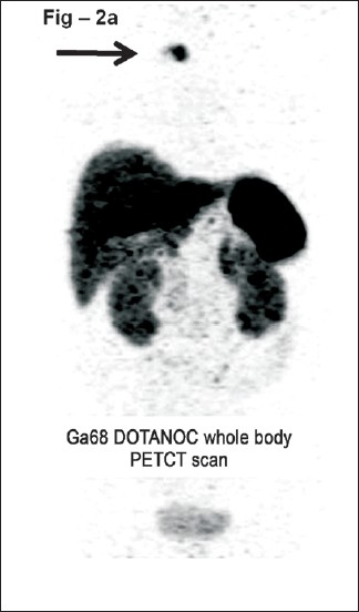 Ga68 Dotanoc whole body PETCT scan. Two well defined smoothly marginated slightly lobulated soft tissue lesions in the right upper anterior chest wall just above the level of jugular notch to the right of midline which are Ga68 Dotanoc avid (arrow).