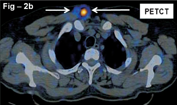 Fused PET CT image. There are two well defined smoothly marginated slightly lobulated soft tissue dense lesions measuring 1.6 × 1.5 cm and 1.2 × 1.2 cm in the right upper anterior chest wall just above the level of jugular notch (arrows).