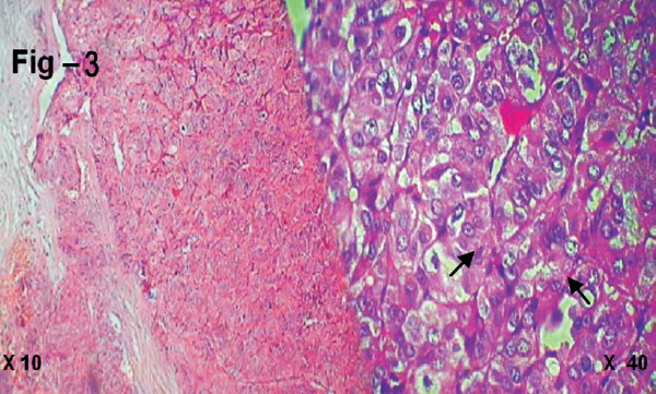 Histology of the excised lesion (×10 and ×40) (weight 5 g) showing cells arranged in trabeculae and nests separated by fibrovascular septae. The cells show moderate to abundant granular cytoplasm, large vesicular nuclei and prominent nucleoli with little mitosis and no necrosis (arrows).
