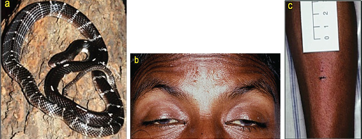 Envenoming by common krait (Bungarus caeruleus): (a) the snake (specimen from Pune, Maharashtra); (b) bilateral ptosis, external ophthalmoplegia and facial paralysis; (c) fang and tooth puncture marks without local swelling in the same patient as 1b.