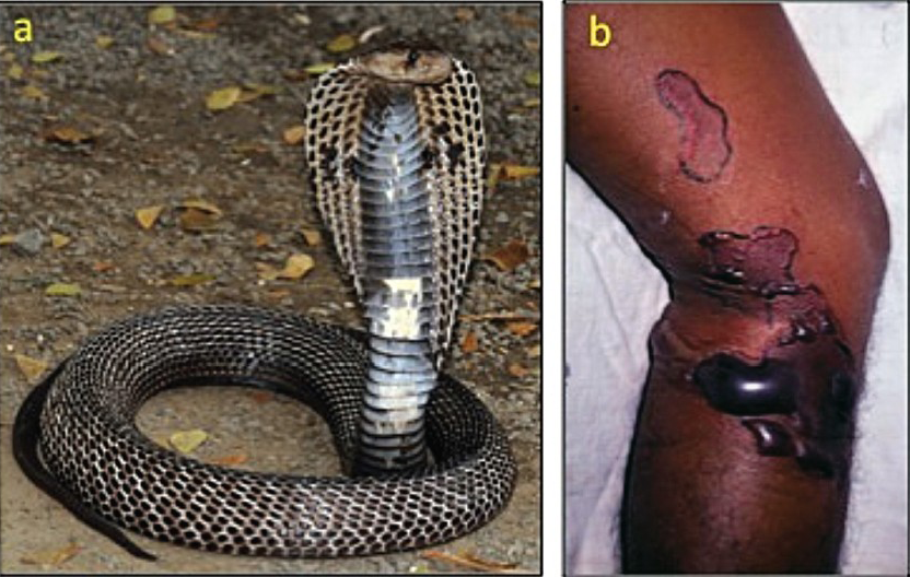 Envenoming by common cobra (Naja naja): (a) the snake (specimen from Pune, Maharashtra); (b) local swelling, blistering and demarcated areas of dermonecrosis in a patient.