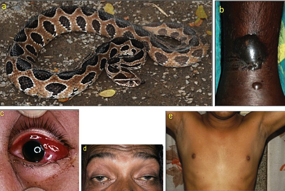 Envenoming by Russell's viper (Daboia russelii): (a) the snake (specimen from Pune, Maharashtra); (b) local swelling and blistering (Kerala); (c) chemosis, a sign of generalized increase in capillary permeability; (d) bilateral ptosis, external ophthalmoplegia and facial paralysis; (e) chronic pan-hypopituitarism (loss of secondary sexual hair and gynaecomastia) following a bite 3 years previously (Kerala).