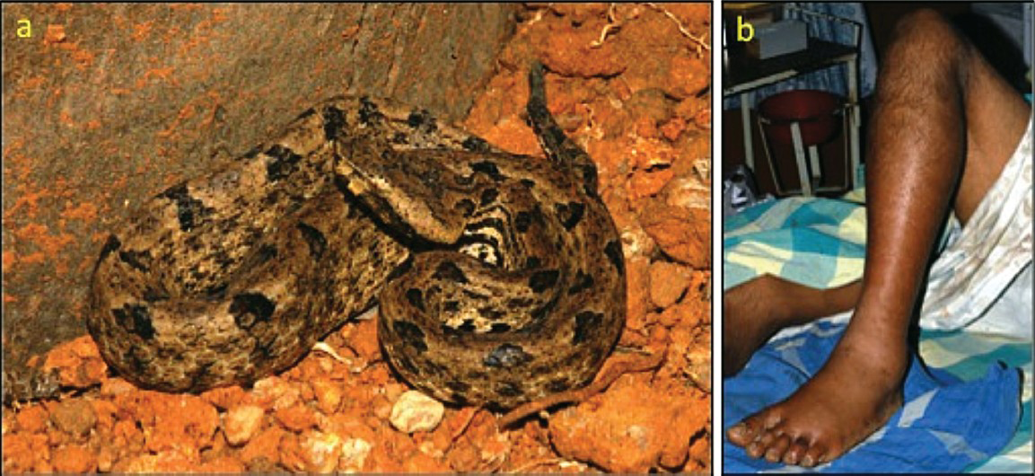 Envenoming by hump-nosed viper (Hypnale hypnale): (a) the snake (specimen from Thattekkad, Kerala); (b) marked local swelling after a bite on the foot (Angamaly, Kerala).