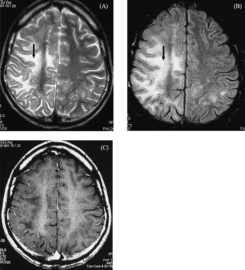 A 30-year old man presented with insidious onset progressive weakness of left side of the body with visual impairment in the left eye for 6 wk duration. A contrast enhanced MRI brain done for the patient shows scalloped, high signal lesion in the right frontoparietal white matter in the axial T2- weighted fast spin-echo (FSE) image (A) (black arrow). The lesion is better seen on axial FLAIR-FSE image (B) (black arrow). There is no mass effect. No enhancement is seen in the contrast enhanced T1-weighted SE image (C). He was diagnosed to be HIV positive and the PCR for JC virus in the CSF was positive.