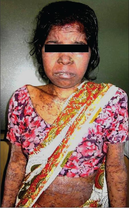 Papular erythematous patches on chest, arms, abdomen and face.