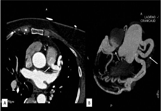 (A) Axial CT coronary angiography image showing origin of left coronary artery from main pulmonary artery (white arrow), and (B) Coronal maximum intensity projection image showing origin of left coronary artery from main pulmonary artery (white arrow with dotted line). Right coronary artery arising normally from aorta is dilated and tortuous (white arrow) with multiple prominent collateral branches.