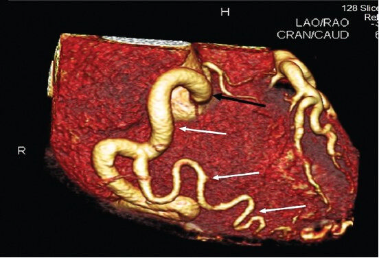 Coronal 3-D volume rendered CT coronary angiography image showing dilated tortuous right coronary artery arising from aorta (black arrow) with dilated collateral branches (white arrows).