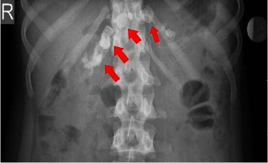 X-ray abdomen showing chunky calcifications along the main pancreatic duct (red arrows).