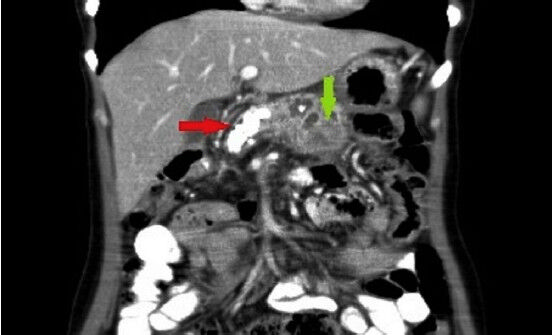 Contrast enhanced CT scan of the abdomen revealing pancreatic calcifications (red arrow) and mass in the body of pancreas (green arrow).