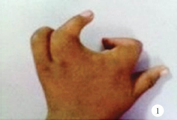 Left hand (dorsal view) shows a median cleft and flexion deformity at proximal inter-phalangeal joints in the index and ring finger.