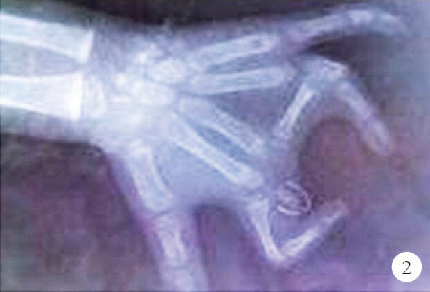 Radiograph of left hand shows a transversely oriented bone between third and fourth metacarpal, third metacarpal was present but phalanges of middle finger were absent except for rudimentary proximal phalanx, carpals were normal.