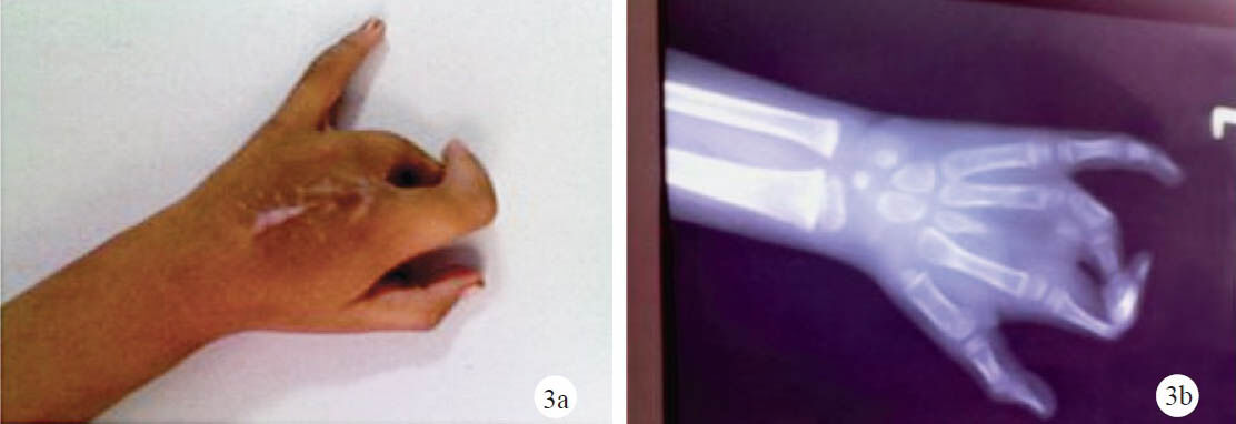 a. Postoperative photograph of left hand (dorsal view) showing a decreased cleft. b. Postoperative radiograph of left hand with an excised transverse bone and third metacarpal (partial).