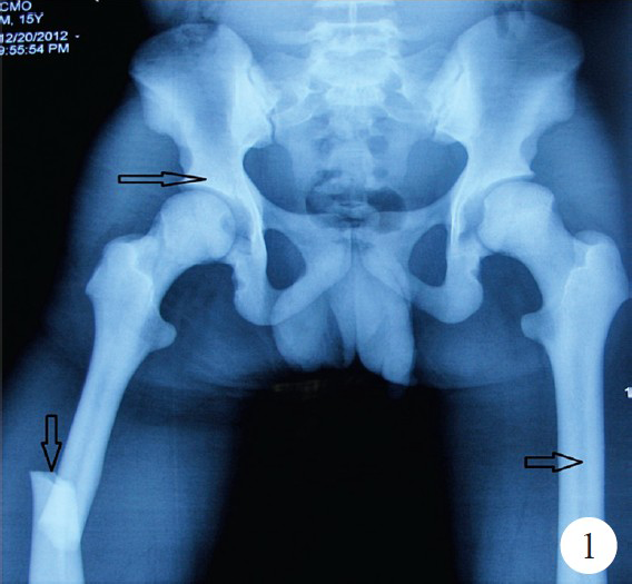 X-ray both hips with thigh showing sclerotic bones, pathological fracture in shaft femur and narrow medullary canal (arrows).