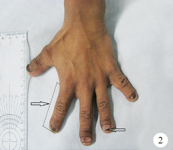 Small fingers and grooved nails (arrow).
