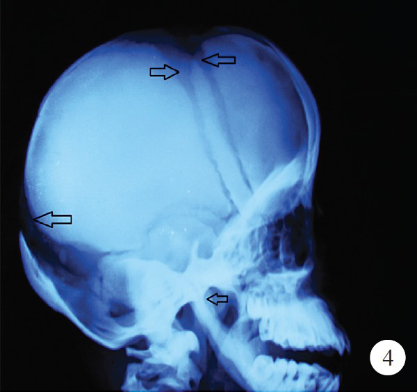 X-ray of skull showing open anterior and posterior fontanelle and obtuse angle of mandible (arrows).