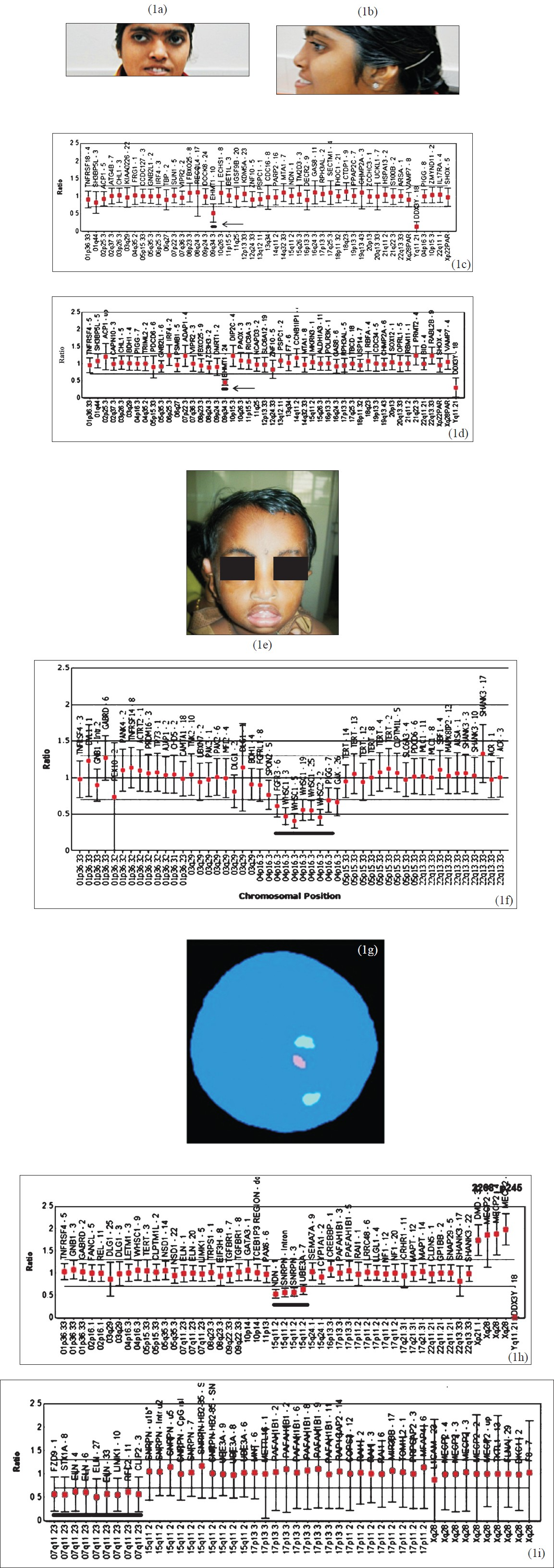 (a) & (b) Facial features of representative case no.2137 with 9q34.3 deletion, note flat face and prognathism. (c & d) MLPA P070 and P036-E1 probe sets results of case no. 2137 showing deletion of 9q34. (e) Facial features of case No.2877 with 4p16.33 deletion, note hypertelorism. (f) MLPA results of case 2877 using P373 confirmatory probe set showing deletion of 4p16.33. (g) FISH result of case 2275 showing single copy of 7q11.2 (pink signal). Green signals are controls (2 copies) (h) MLPA profile showing deletion at 7q11.29 using P245-A2 probe set (i) MLPA profile showing deletion at 7q11.29 using P374 confirmatory probe set.