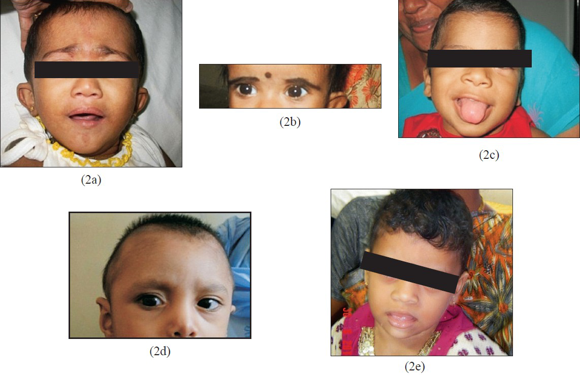 (a) Case no. 2222- Deletion 1pter. Note straight eybrows (b) Case no. 2364 - Deletion 1pter. Note deep seated eyes (c) Case no. 2604 –Deletion 9pter (d) Case no. 2582- Deletion of 13qter (e) Case no. 2268- Deletion 15q11.2 with features though not characteristic but supportive of Angelman syndrome.