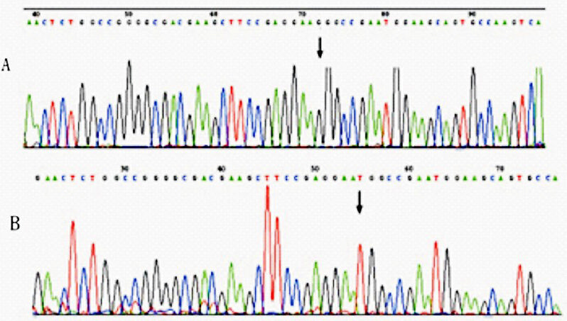 Chromatograms showing nucleotide sequence of ADD1 gene G614T polymorphism. (A) Normal allele with G, (B) mutant allele with T. Substitution of the nucleotide indicated by arrows.
