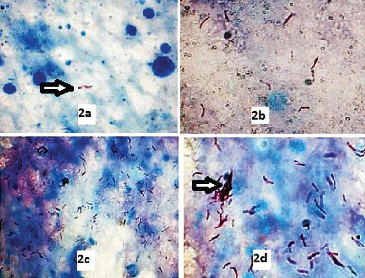 AFB grading on Z-N stained smears. 2a. Grade 1 + (ZN stain 1000X). 2b. Grade 2+ (ZN stain 1000X). 2c. Grade 3+ (ZN stain 400X). 2d. Grade 3+ (ZN stain 1000X).