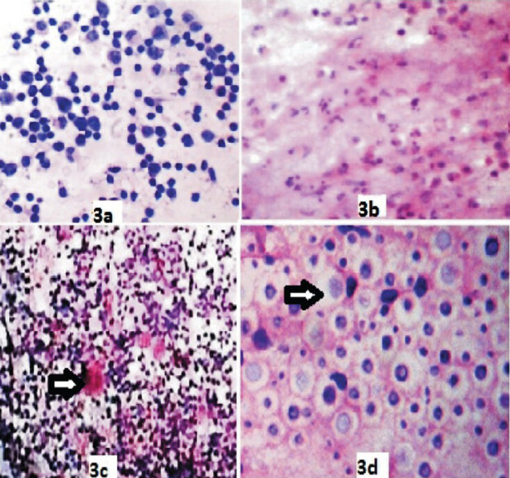 Various non neoplastic cytological patterns of HIV lymphadenopathy on FNAC. 3a. Reactive lymphadenitis showing polymorphous lymphoid population (H&E 400X). 3b. Suppurative lymphadenitis with degenerating neutrophils (H&E 400X). 3c. Non specific granulomatous lesion (H&E 100X) 3d. Cryptococci showing capsule (H&E 1000X).