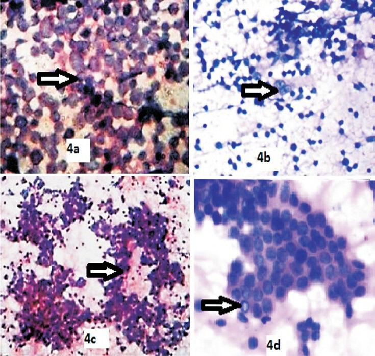 Various neoplastic cytological patterns of HIV lymphadenopathy on FNAC. 4a. Non Hodgkin's lymphoma showing monotonous population of lymphoid cells (H&E 400X). 4b. Hodgkin's lymphoma showing Reed Sternberg cell (H&E 100X). 4c. Papillary adenocarcinomatous deposits showing papillae with fibrovascular cores (H&E 100X). 4d. Papillary adenocarcinomatous deposits showing papillae with intranuclear inclusions (H&E 400X).