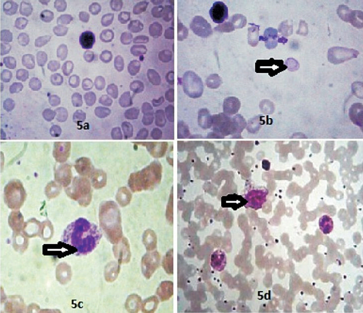 Haematological alterations in HIV seropositive patients?. 5a. Microcytic hypochromic anaemia (Leishman stain 400X). 5b. Macrocytic anaemia showing cabot ring (Leishman stain, 1000X). 5c. Neutrophil with toxic granules (Leishman stain, 1000X). 5d. Showing a reactive lymphocyte (Leishman stain, 400X).
