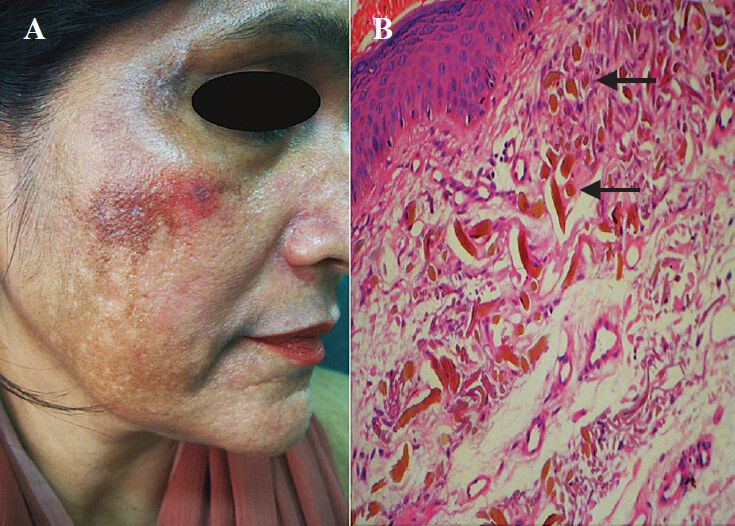 A. Bluish-black spotty pigmentation on face B. Skin biopsy showing ocher coloured fibers in the dermis (arrow) (H & E, × 100).
