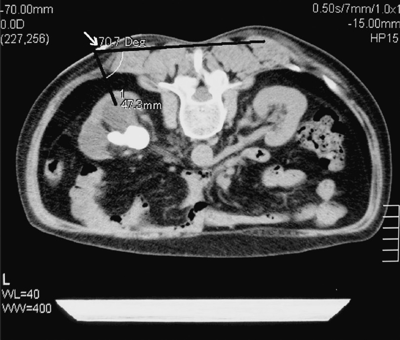 The presumed percutaneous puncture point, puncture depth, and angulation were determined on the right axial surface slice. A 65-year-old women with left renal stone: the puncture depth from the DTZ-coated fabric particle (the presumed puncture point, white arrow) to dilatate the post-calyx is 47.3 mm, and the puncture angulation, which means the included angle between puncture route and human back body plane, is 70.7 degree.