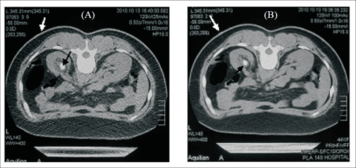 Direct signs of renal calculi and DTZ-coated fabric particles were detected in patients on both low-dose CT and standard-dose CT images. A 28-year-old woman with left renal calculus: upper abdomen axial low-dose CT image (120 kV, 25 mAs, pitch of 1.00, 7-mm collimation) (A) shows a pelvic stone (black arrow) and DTZ-coated fabric particle (white arrow). Same findings are shown on standard-dose CT image (120 kV, 100 mAs, pitch of 1, 7-mm collimation) (B).
